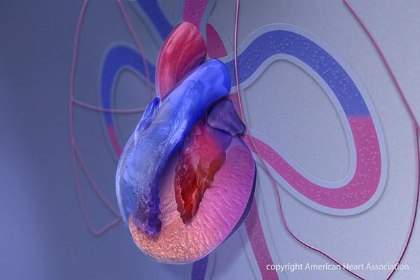 3D medical illustration of a human heart showing cardiomyopathy: the heart appears enlarged and misshapen, with thickened and stretched walls. The exterior is colored in red, pink, and blue to distinguish structures, and a cross-section reveals the inner chamber with a narrowed cavity. Stylized blood vessels and a simplified chest outline form the background. A small “copyright American Heart Association” watermark appears in the lower right corner.